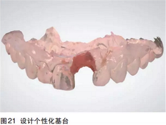 前牙即刻種植并個(gè)性化基臺(tái)美學(xué)修復(fù) 前牙即刻種植并個(gè)性化基臺(tái)美學(xué)修復(fù)