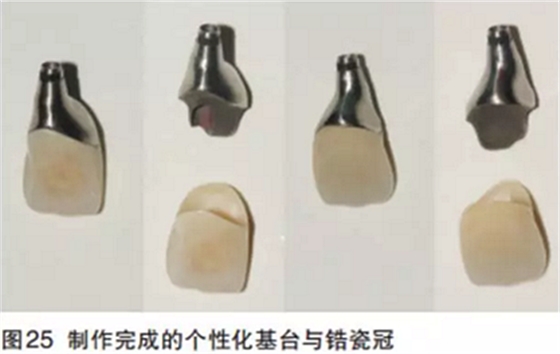 前牙即刻種植并個(gè)性化基臺(tái)美學(xué)修復(fù) 前牙即刻種植并個(gè)性化基臺(tái)美學(xué)修復(fù)