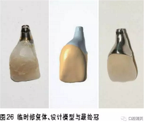 前牙即刻種植并個(gè)性化基臺(tái)美學(xué)修復(fù) 前牙即刻種植并個(gè)性化基臺(tái)美學(xué)修復(fù)