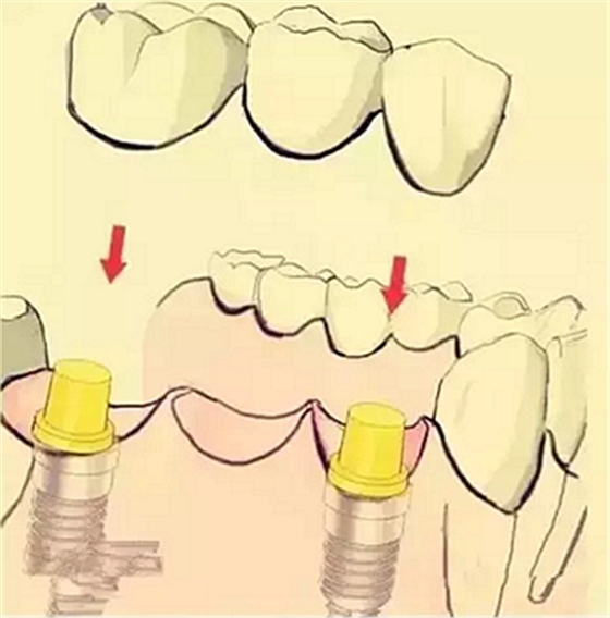 【牙齒種植】健康牙齒“種”出來(lái) 【牙齒種植】健康牙齒“種”出來(lái)