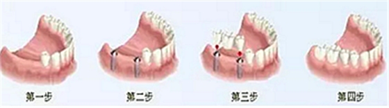 【牙齒種植】健康牙齒“種”出來(lái) 【牙齒種植】健康牙齒“種”出來(lái)