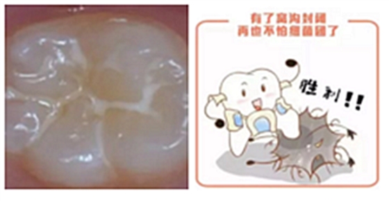 窩溝封閉 窩溝封閉