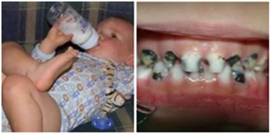 窩溝封閉 窩溝封閉