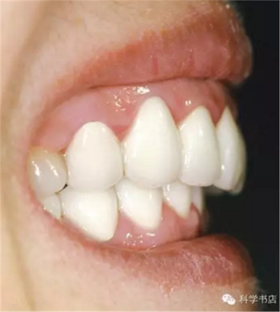 固定修復(fù)中的咬合問題與處理原則 固定修復(fù)中的咬合問題與處理原則