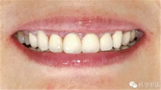 固定修復(fù)中的咬合問題與處理原則 固定修復(fù)中的咬合問題與處理原則