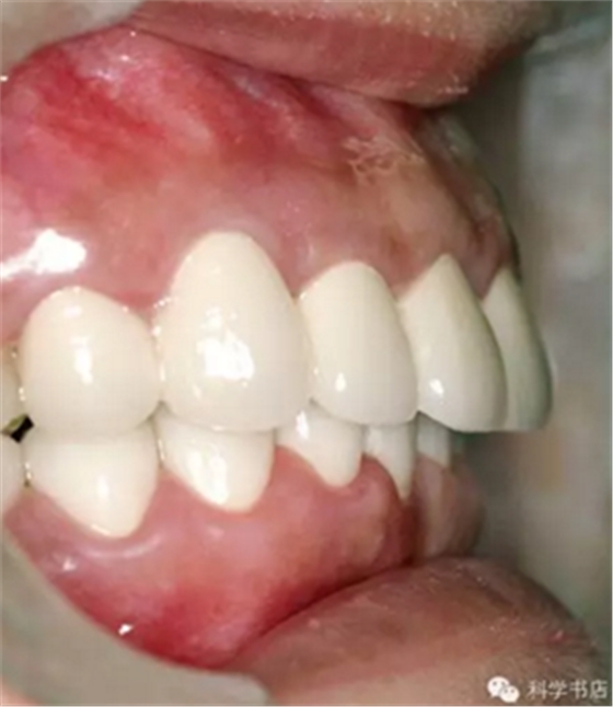 固定修復(fù)中的咬合問題與處理原則 固定修復(fù)中的咬合問題與處理原則