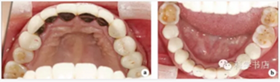 固定修復(fù)中的咬合問題與處理原則 固定修復(fù)中的咬合問題與處理原則