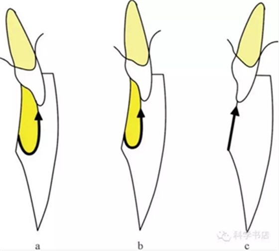 固定修復(fù)中的咬合問題與處理原則 固定修復(fù)中的咬合問題與處理原則
