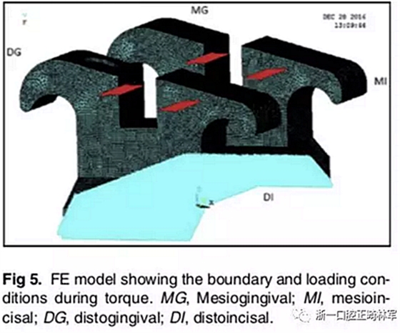 正畸文獻(xiàn)閱讀--不銹鋼托槽與鈦托槽形變差異的有限元分析 正畸文獻(xiàn)閱讀--不銹鋼托槽與鈦托槽形變差異的有限元分析