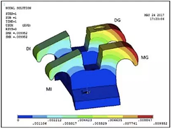 正畸文獻(xiàn)閱讀--不銹鋼托槽與鈦托槽形變差異的有限元分析 正畸文獻(xiàn)閱讀--不銹鋼托槽與鈦托槽形變差異的有限元分析