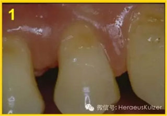 簡(jiǎn)單治療——格魯瑪脫敏劑的應(yīng)用 簡(jiǎn)單治療——格魯瑪脫敏劑的應(yīng)用