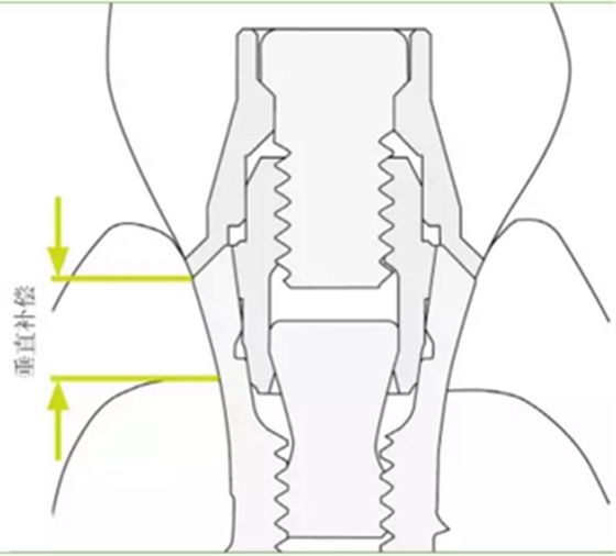 揭秘士卓曼種植體-基臺的長期穩(wěn)定性 揭秘士卓曼種植體-基臺的長期穩(wěn)定性