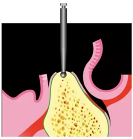 Camlog種植體外科種植小技巧 Camlog種植體外科種植小技巧