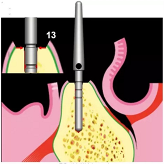 Camlog種植體外科種植小技巧 Camlog種植體外科種植小技巧