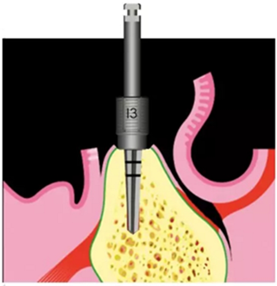 Camlog種植體外科種植小技巧 Camlog種植體外科種植小技巧