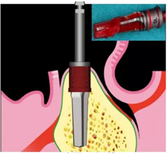 Camlog種植體外科種植小技巧 Camlog種植體外科種植小技巧