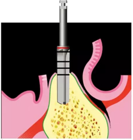 Camlog種植體外科種植小技巧 Camlog種植體外科種植小技巧