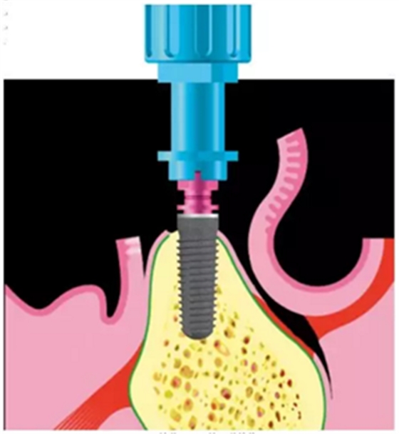 Camlog種植體外科種植小技巧 Camlog種植體外科種植小技巧