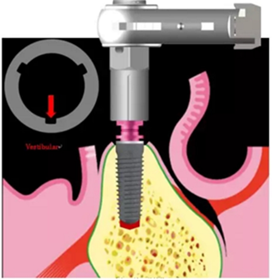 Camlog種植體外科種植小技巧 Camlog種植體外科種植小技巧