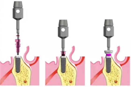 Camlog種植體外科種植小技巧 Camlog種植體外科種植小技巧