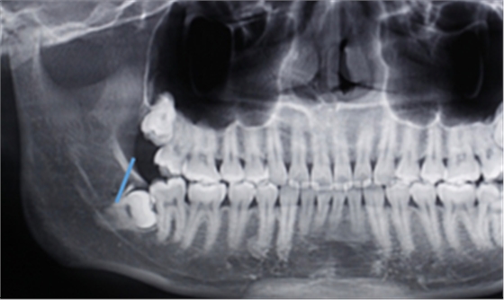 [頜面外科] 趙吉宏教授教你分析阻生牙阻力及畫分冠線