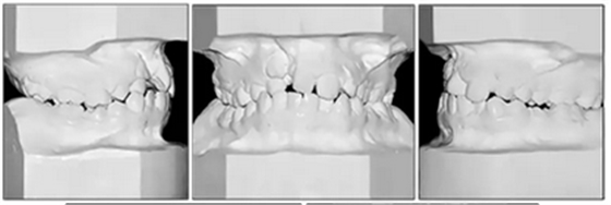 正畸文獻(xiàn)閱讀--單側(cè)唇腭裂患者的多學(xué)科綜合序列治療 正畸文獻(xiàn)閱讀--單側(cè)唇腭裂患者的多學(xué)科綜合序列治療