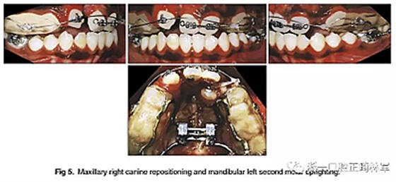 正畸文獻(xiàn)閱讀--單側(cè)唇腭裂患者的多學(xué)科綜合序列治療 正畸文獻(xiàn)閱讀--單側(cè)唇腭裂患者的多學(xué)科綜合序列治療