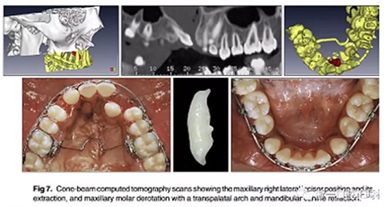 正畸文獻(xiàn)閱讀--單側(cè)唇腭裂患者的多學(xué)科綜合序列治療 正畸文獻(xiàn)閱讀--單側(cè)唇腭裂患者的多學(xué)科綜合序列治療