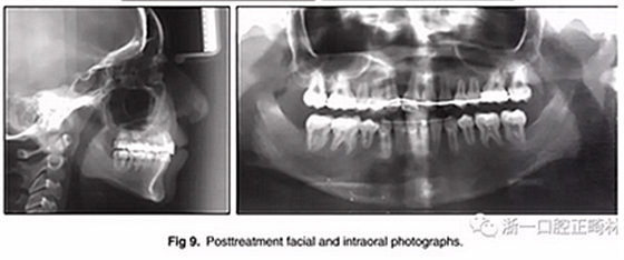 正畸文獻(xiàn)閱讀--單側(cè)唇腭裂患者的多學(xué)科綜合序列治療 正畸文獻(xiàn)閱讀--單側(cè)唇腭裂患者的多學(xué)科綜合序列治療