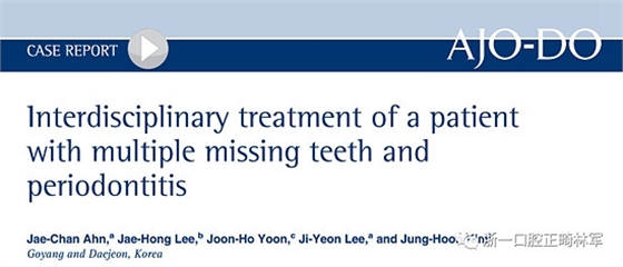 文獻優(yōu)秀正畸病例賞析--多顆牙齒缺失的牙周炎患者的跨學科綜合治療 文獻優(yōu)秀正畸病例賞析--多顆牙齒缺失的牙周炎患者的跨學科綜合治療