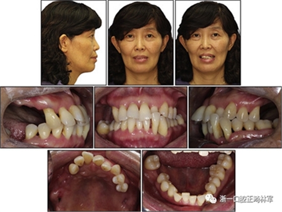 文獻優(yōu)秀正畸病例賞析--多顆牙齒缺失的牙周炎患者的跨學科綜合治療 文獻優(yōu)秀正畸病例賞析--多顆牙齒缺失的牙周炎患者的跨學科綜合治療