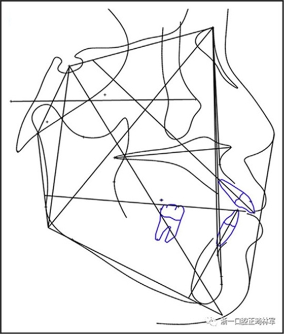 文獻優(yōu)秀正畸病例賞析--多顆牙齒缺失的牙周炎患者的跨學科綜合治療 文獻優(yōu)秀正畸病例賞析--多顆牙齒缺失的牙周炎患者的跨學科綜合治療