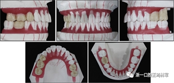 文獻優(yōu)秀正畸病例賞析--多顆牙齒缺失的牙周炎患者的跨學科綜合治療 文獻優(yōu)秀正畸病例賞析--多顆牙齒缺失的牙周炎患者的跨學科綜合治療