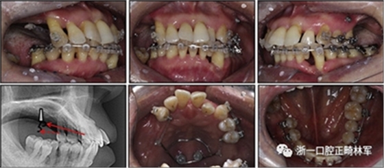 文獻優(yōu)秀正畸病例賞析--多顆牙齒缺失的牙周炎患者的跨學科綜合治療 文獻優(yōu)秀正畸病例賞析--多顆牙齒缺失的牙周炎患者的跨學科綜合治療