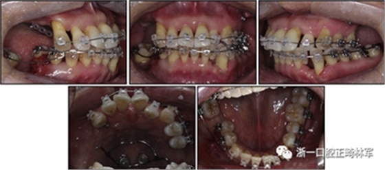 文獻優(yōu)秀正畸病例賞析--多顆牙齒缺失的牙周炎患者的跨學科綜合治療 文獻優(yōu)秀正畸病例賞析--多顆牙齒缺失的牙周炎患者的跨學科綜合治療