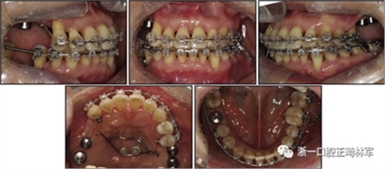 文獻優(yōu)秀正畸病例賞析--多顆牙齒缺失的牙周炎患者的跨學科綜合治療 文獻優(yōu)秀正畸病例賞析--多顆牙齒缺失的牙周炎患者的跨學科綜合治療