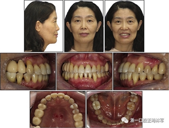 文獻優(yōu)秀正畸病例賞析--多顆牙齒缺失的牙周炎患者的跨學科綜合治療 文獻優(yōu)秀正畸病例賞析--多顆牙齒缺失的牙周炎患者的跨學科綜合治療