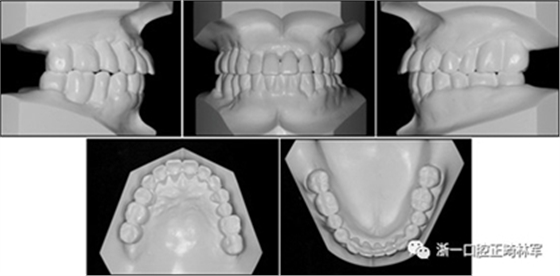 文獻優(yōu)秀正畸病例賞析--多顆牙齒缺失的牙周炎患者的跨學科綜合治療 文獻優(yōu)秀正畸病例賞析--多顆牙齒缺失的牙周炎患者的跨學科綜合治療