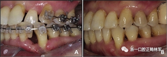 文獻優(yōu)秀正畸病例賞析--多顆牙齒缺失的牙周炎患者的跨學科綜合治療 文獻優(yōu)秀正畸病例賞析--多顆牙齒缺失的牙周炎患者的跨學科綜合治療