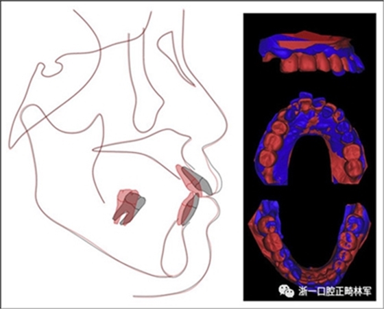 文獻優(yōu)秀正畸病例賞析--多顆牙齒缺失的牙周炎患者的跨學科綜合治療 文獻優(yōu)秀正畸病例賞析--多顆牙齒缺失的牙周炎患者的跨學科綜合治療