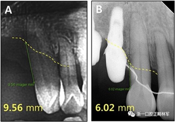 文獻優(yōu)秀正畸病例賞析--多顆牙齒缺失的牙周炎患者的跨學科綜合治療 文獻優(yōu)秀正畸病例賞析--多顆牙齒缺失的牙周炎患者的跨學科綜合治療