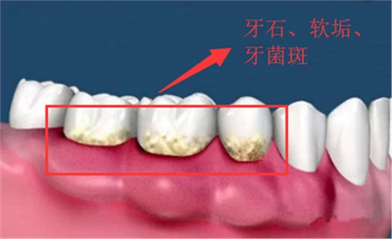 99%的人都不知道怎樣才算把牙齒刷干凈了！