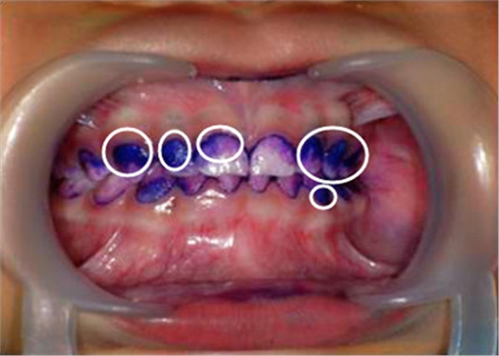99%的人都不知道怎樣才算把牙齒刷干凈了！