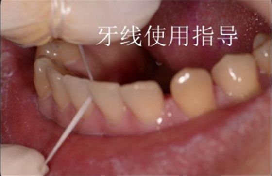 99%的人都不知道怎樣才算把牙齒刷干凈了！