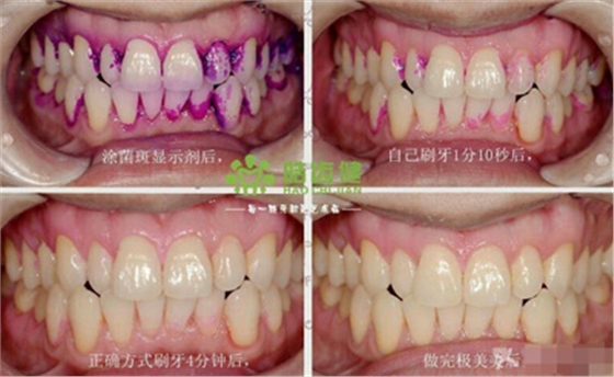 99%的人都不知道怎樣才算把牙齒刷干凈了！