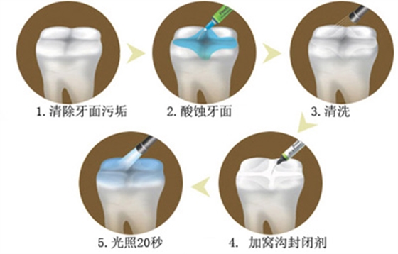 窩溝封閉丨孩子牙齒的“鎧甲勇士” 窩溝封閉丨孩子牙齒的“鎧甲勇士”