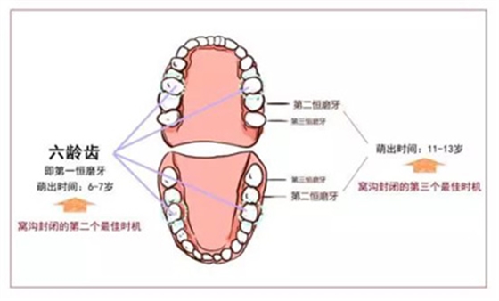 窩溝封閉丨孩子牙齒的“鎧甲勇士” 窩溝封閉丨孩子牙齒的“鎧甲勇士”