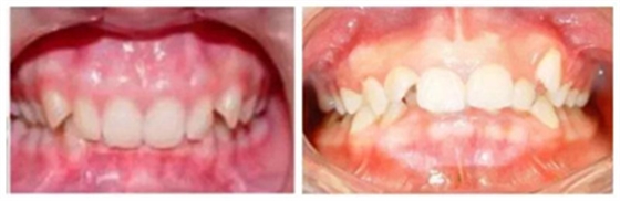 12歲前必須處理的20種兒童牙頜畸形【口腔科普】 12歲前必須處理的20種兒童牙頜畸形【口腔科普】