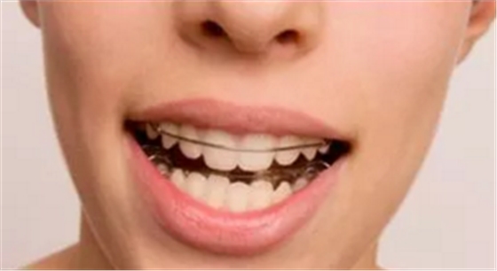 牙齒矯正適應(yīng)癥的表現(xiàn) 牙齒矯正適應(yīng)癥的表現(xiàn)