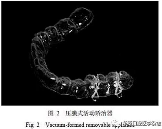 利用壓膜式活動(dòng)矯治器壓入下頜第一、第二磨牙1例